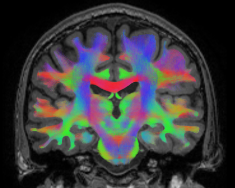 Coronal slab visualization of a whole brain tractogram.